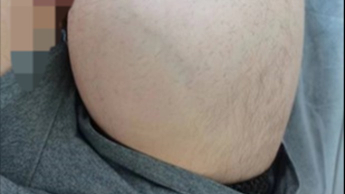30岁男子大腿肿物疯长，脂肪肉瘤与脂肪瘤一字之差良恶性差别巨大